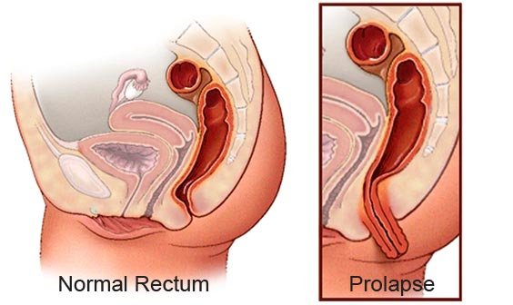 Rectal Prolapse