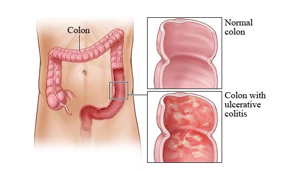 Is Ulcerative Colitis Curable?: Digestive Disease Specialists
